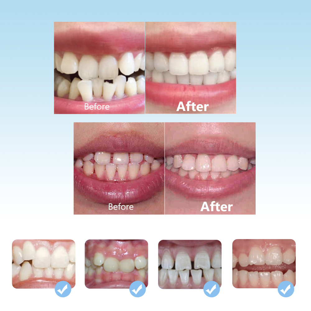 치과 교정 치과 교정기 세트 3 단계 실리콘 정렬 트레 - Teeth Whitening Retainer 리뷰 및 가격