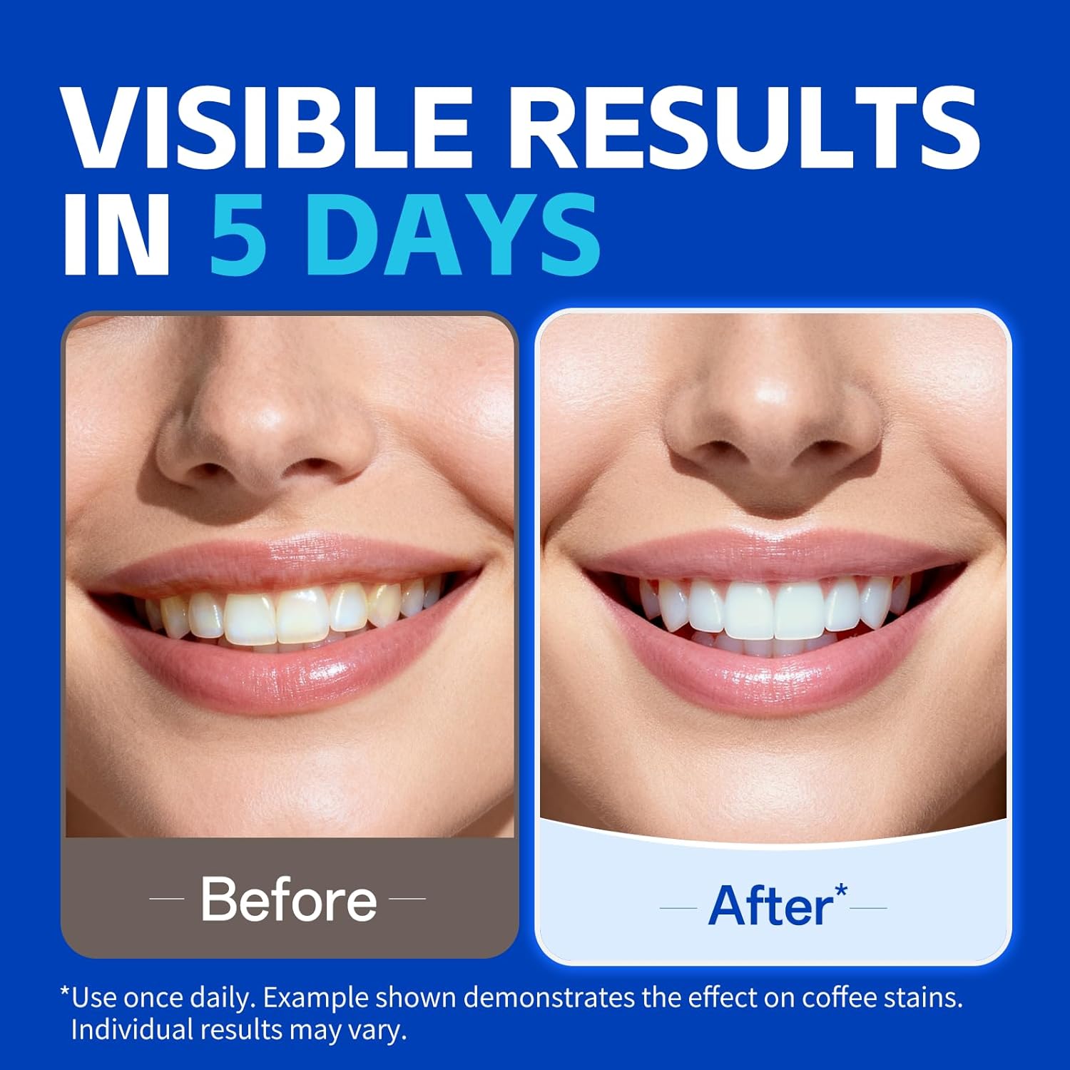 7쌍의 치아 미백 스트립으로 더 하얗게 보이는 미소를  - Teeth Whitening Retainer 리뷰 및 가격