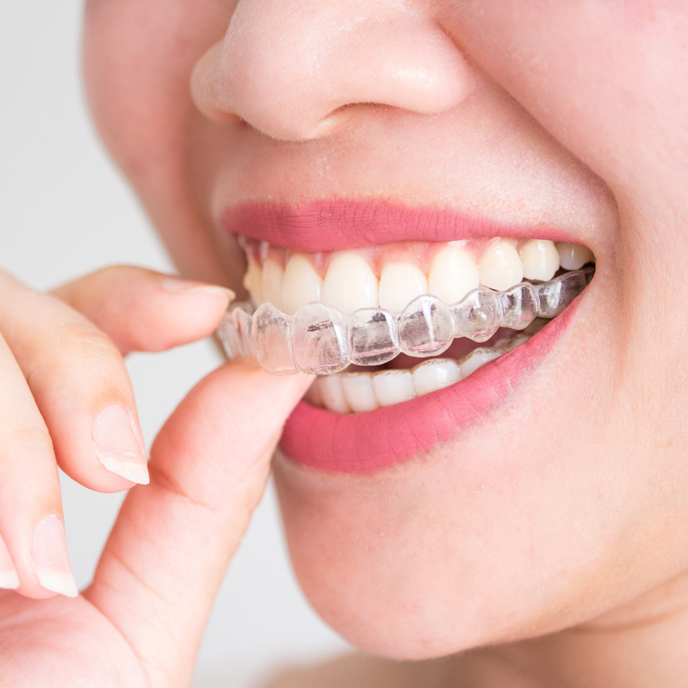 2/4개입 전문 치아 교정기 세트 투명 마우스가드 위생 - Teeth Whitening Retainer 리뷰 및 가격