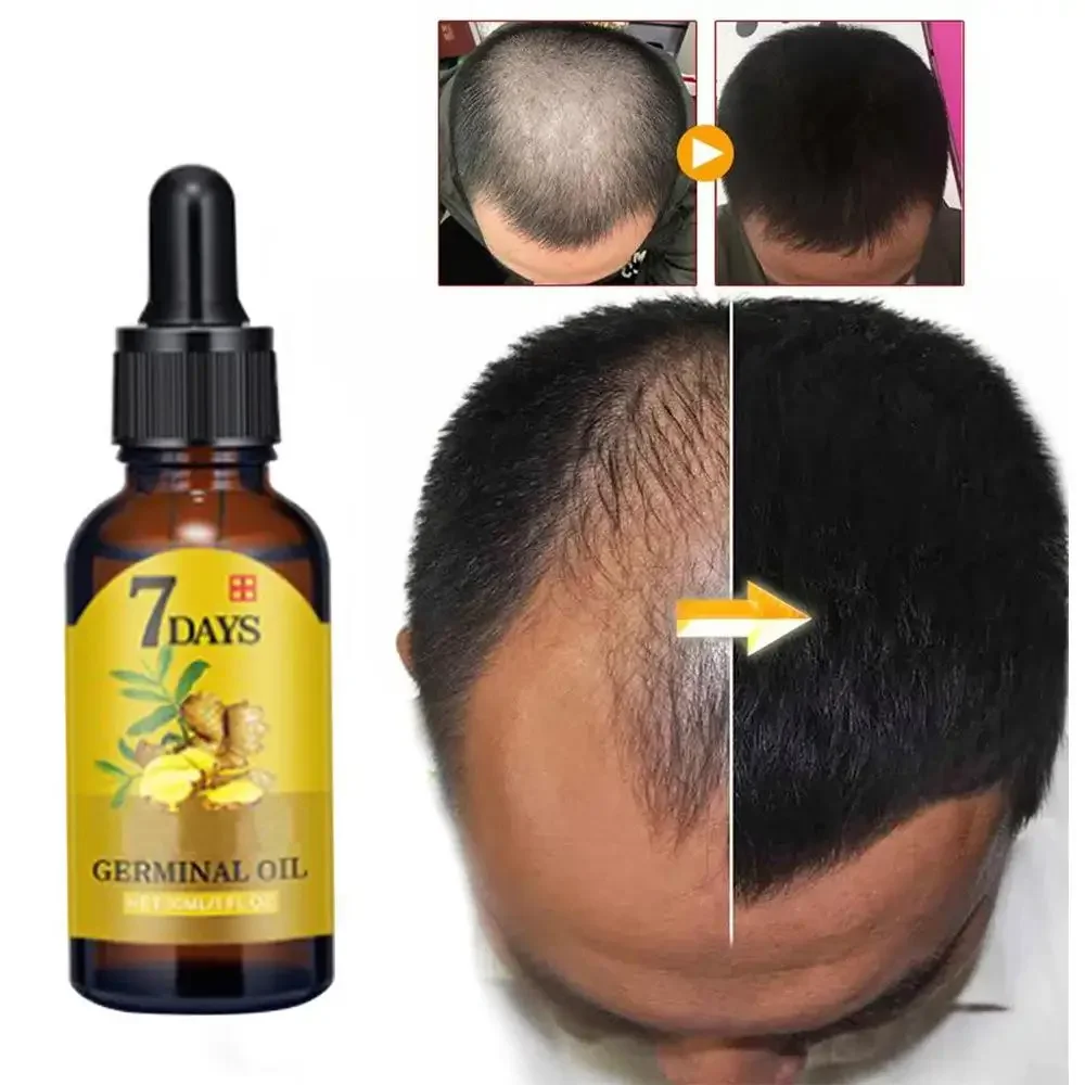 모발 성장 생강 빠르게 성장하는 모발 에센셜 오일 헤어 - Coconut Oil Pull 리뷰 및 가격